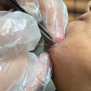 الکترولیز موی سفید