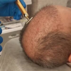 پی آر پی مزوتراپی مو و ابرو